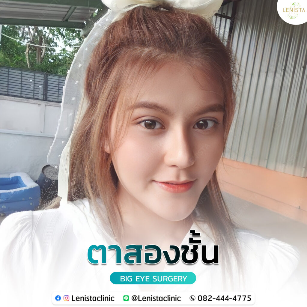 รีวิวศัลยกรรมตาสองชั้น