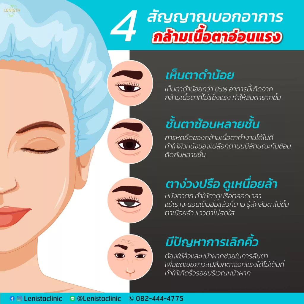 4 สัญญาณ บอกอาการกล้ามเนื้อตาอ่อนแรง